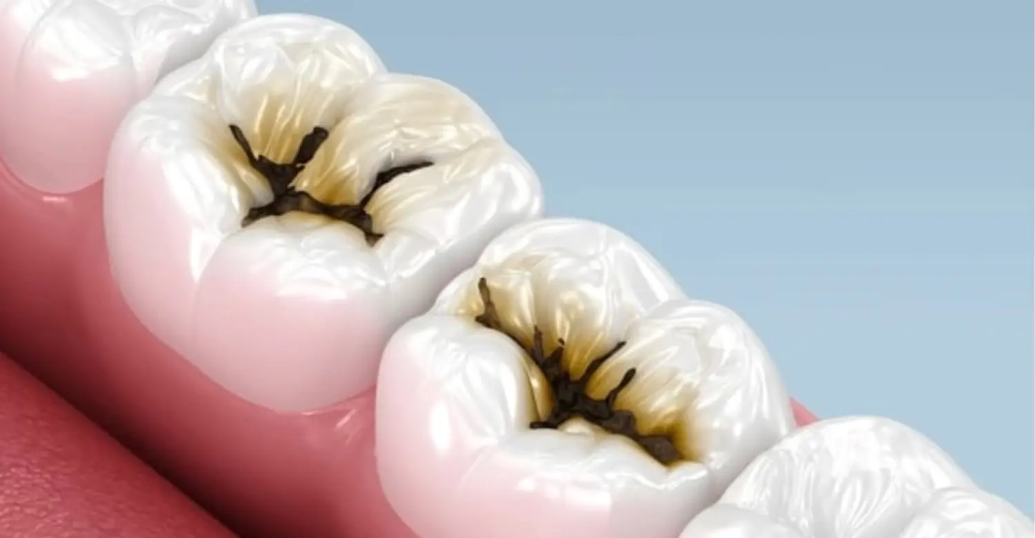 cavity repair 2